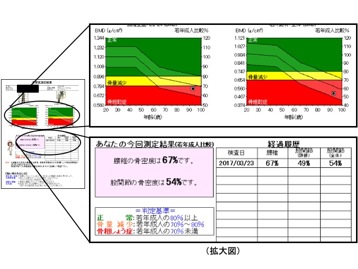 大腿骨近位部骨折に対する骨折連鎖予防 骨心アプローチ 整形外科 診療科 部門紹介 ベルランド総合病院 社会医療法人 生長会