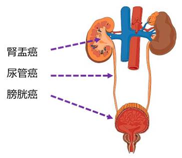 腎盂 尿管癌 泌尿器科 診療科 部門紹介 ベルランド総合病院 社会医療法人 生長会