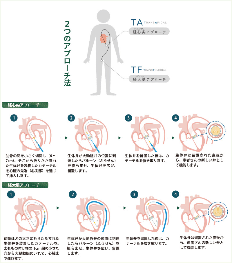 TAVR－経カテーテル大動脈弁置換術｜心臓血管外科｜診療科・部門紹介