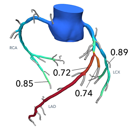 /bell/upload/department/page/HeartFlow_Analysis_-_Example_3D_Model.png