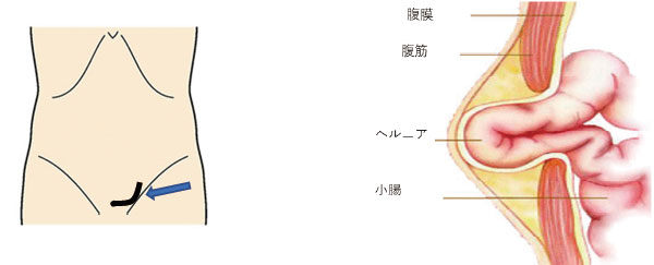 /ozumc/upload/department/page/herunia01.jpg