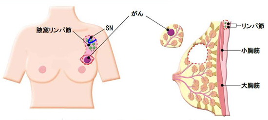 /ozumc/upload/department/page/mammary14.jpg