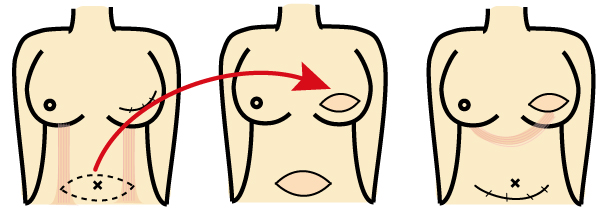 /ozumc/upload/department/page/mammary18_tram.jpg