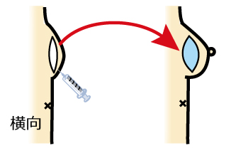 /ozumc/upload/department/page/mammary19_implant.jpg