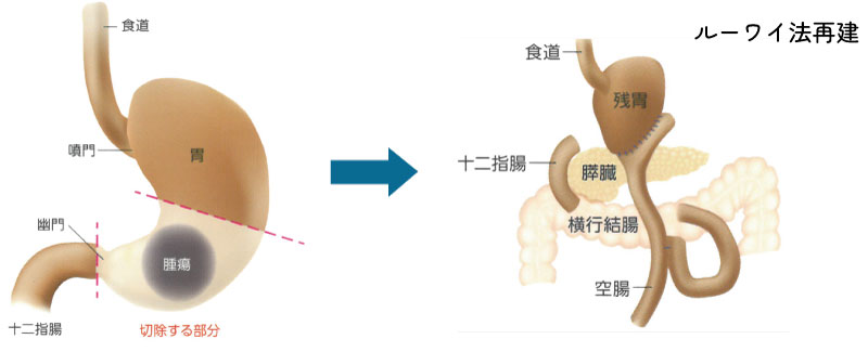 /ozumc/upload/department/page/stoma03.jpg