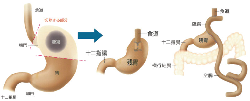 /ozumc/upload/department/page/stoma04.jpg