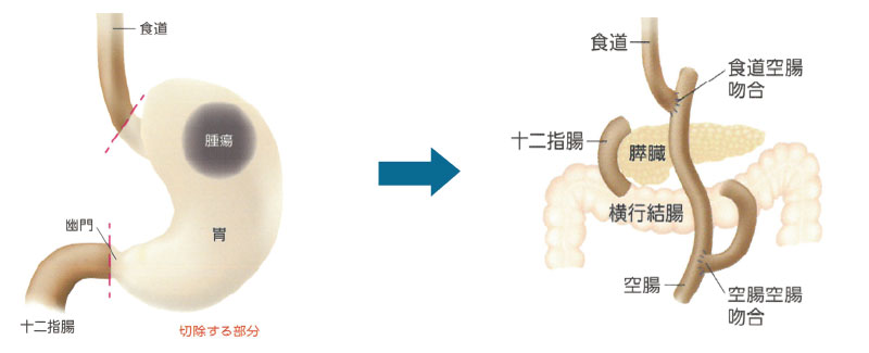 /ozumc/upload/department/page/stoma05.jpg