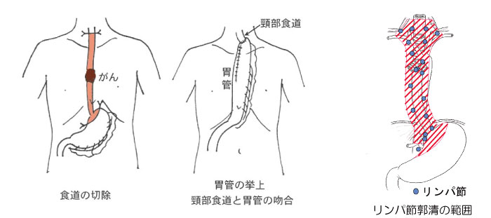 /ozumc/upload/department/page/stoma08.jpg
