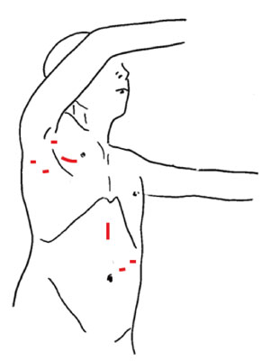 /ozumc/upload/department/page/stoma09.jpg