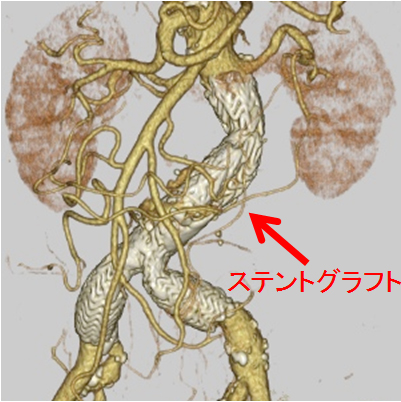 ステントグラフト後