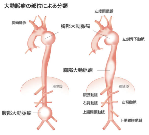 大動脈瘤　部位