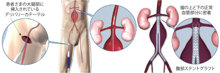 ステントグラフト内挿術　方法
