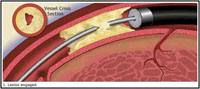 冠動脈形成術