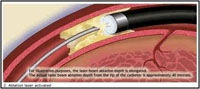冠動脈形成術2