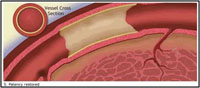 冠動脈形成術4