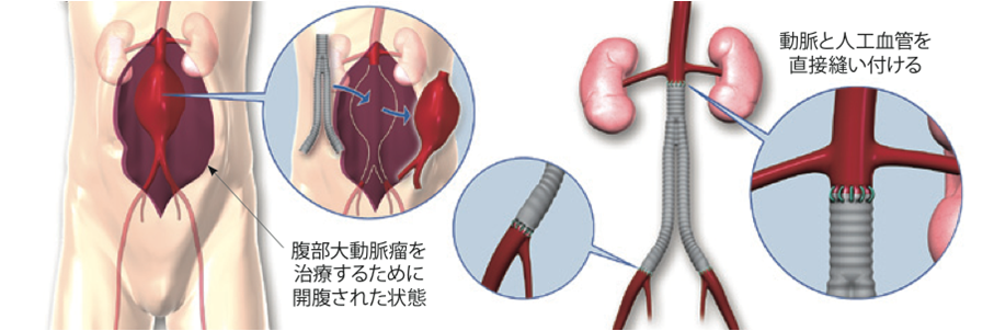 ステントグラフト内挿術｜心臓血管外科｜診療科・部門紹介｜ベルランド